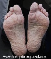 trench feet